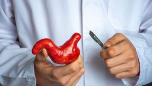 چه افرادی کاندید جراحی چاقی هستند؟