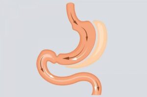 اسلیو استاندارد در مقابل اسلیو ساسی: مقایسه کامل تفاوت‌ ها، نتایج و انتخاب مناسب برای جراحی لاغری