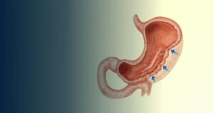 کوچک کردن معده با لیزر؛ آیا واقعاً جایگزین اسلیو معده است؟