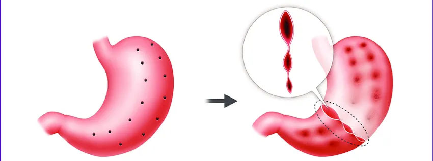فرایند عمل کوچک کردن معده با لیزر