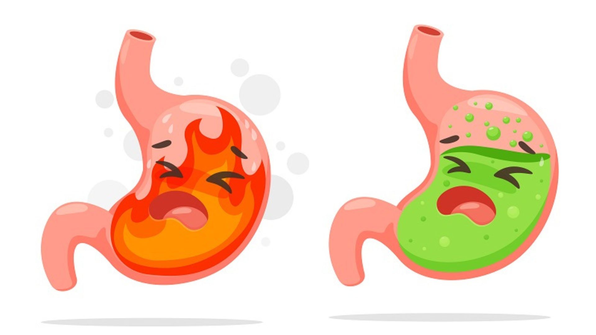 اسید معده و مشکلات گوارشی بعد از عمل اسلیو