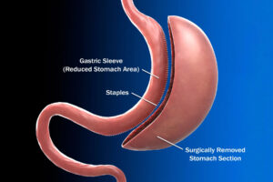 اسلیو معده چگونه انجام می شود