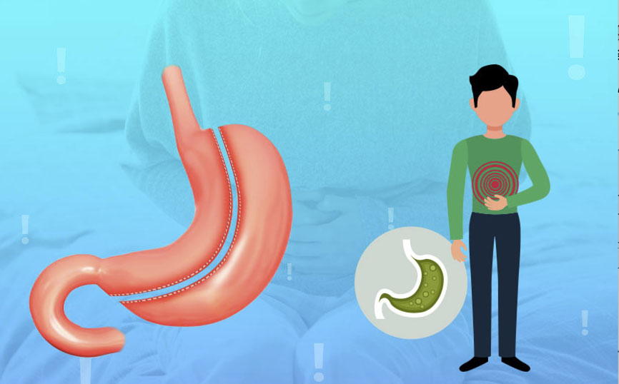 اسید معده و عمل اسلیو