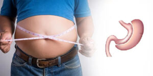 عوارض اسلیو معده و نحوه پیشگیری از عوارض طولانی مدت