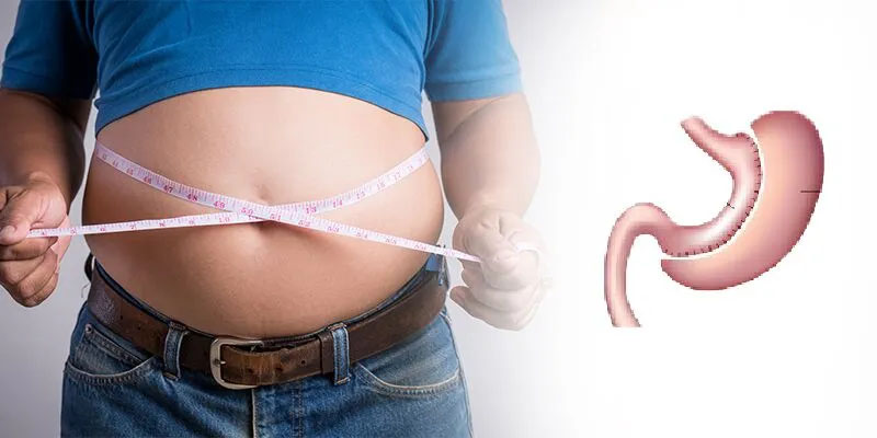 عوارض اسلیو معده و نحوه پیشگیری از عوارض طولانی مدت