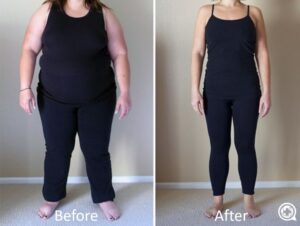 قبل و بعد از جراحی اسلیو