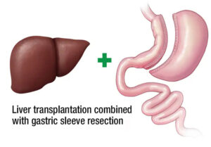 عمل اسلیو معده در درمان کبد جرب