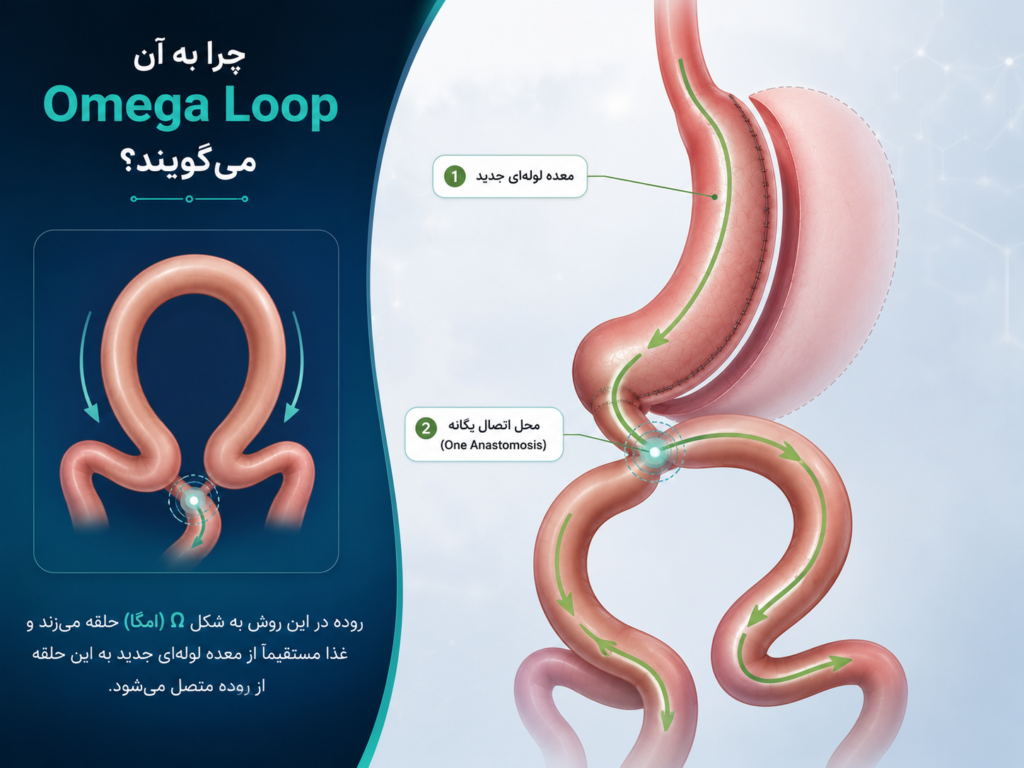 شکل اتصال امگا شکل در جراحی مینی بای‌پس معده یک آناستوموزی