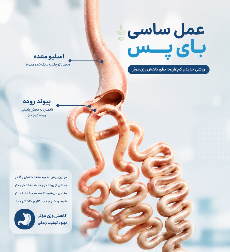 مزایای ساسی بای پس معده؛ کم خطرترین روش لاغری